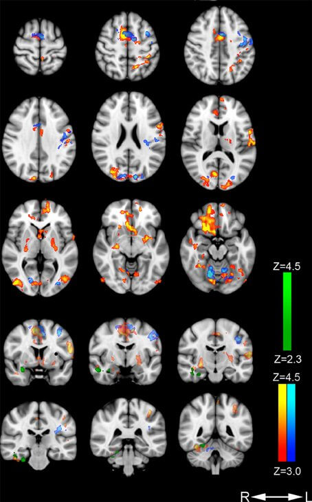 brain scans of non-directive meditation vs resting